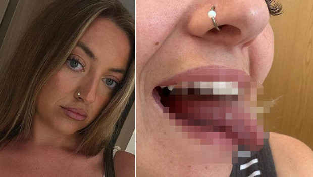 Ağız yarası sanıldı, kanser çıktı! 25 yaşındaki genç kadının dili için kritik ameliyat kararı