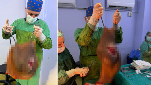 Aydın’da 67 yaşındaki karnından 40 kilogram kitle çıkarıldı
