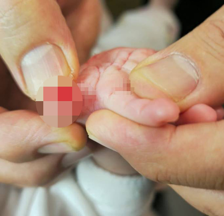 Hemşire, makasla sargıyı keserken bebeğin parmağını kopardı